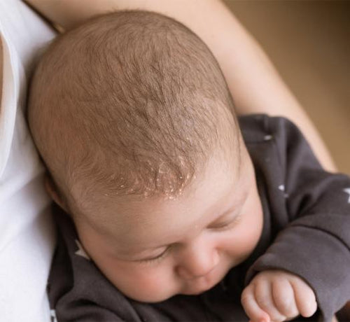 Find out more about cradle cap - Mustela Multi-market - 1
