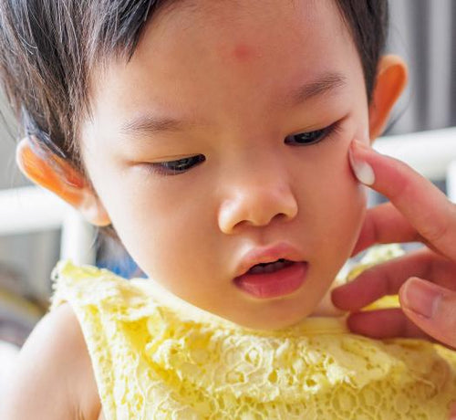 How to care for atopic-prone skin? - Mustela Multi-market - 1